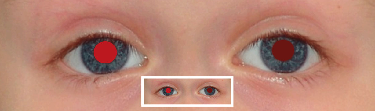 Brückner-Test Cataracte diffuse œil gauche